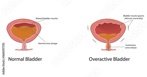 Overactive bladder (OAB) vector illustration