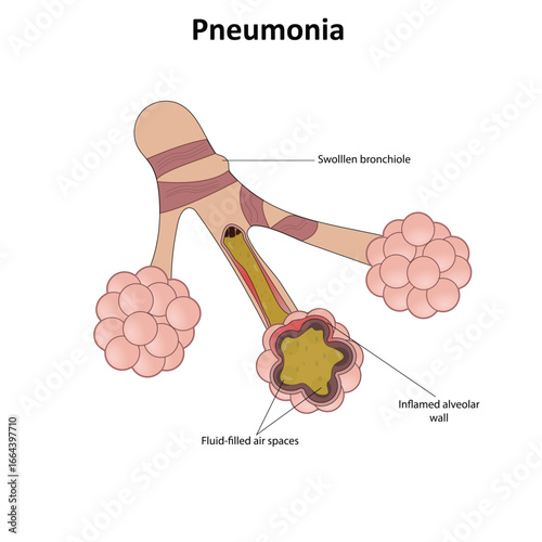 Pneumonia vector illustration