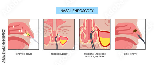 Nasal endoscopy poster