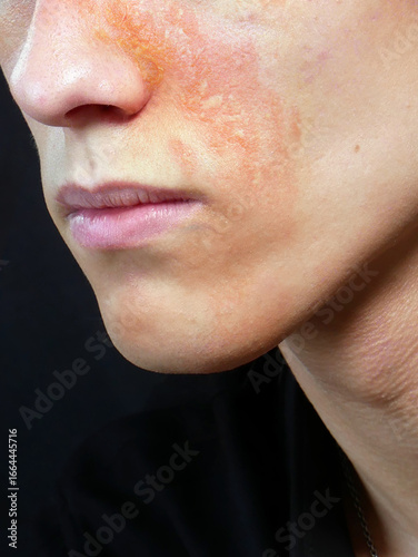 Young man with signs of atopic dermatitis on his face.
