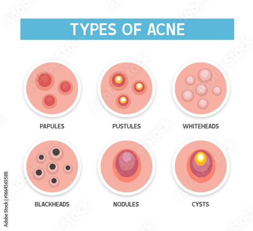 Types of acne. Vector illustration isolated on white background.