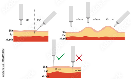 Insulin injection technique. Correct and incorrect way. Cross-section of skin structure. Flat vector illustration