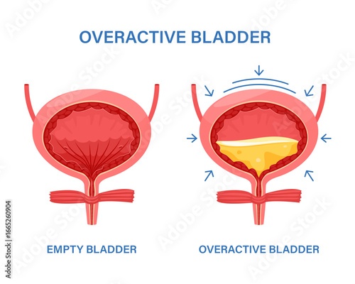 Overactive bladder, often leak anuria, bed wetting toilet urination, urge pass urine of pelvic. Floor muscle frequently, tract tumor, cancer, stroke.
