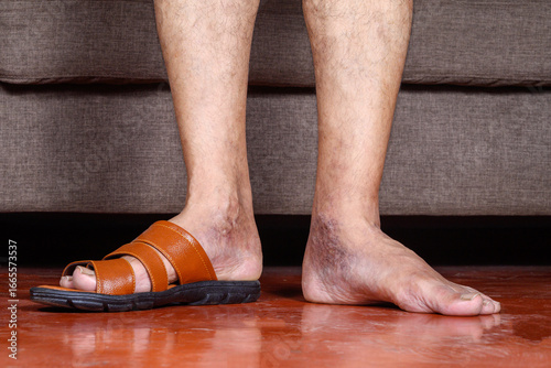 Close-Up of Male Legs with Visible Skin Conditions Wearing Sandals