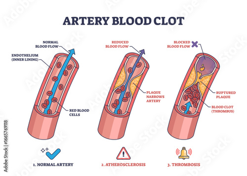 Artery blood clot diagram shows normal artery, atherosclerosis, and thrombosis stages with blood flow, plaque, and clot, transparent background.