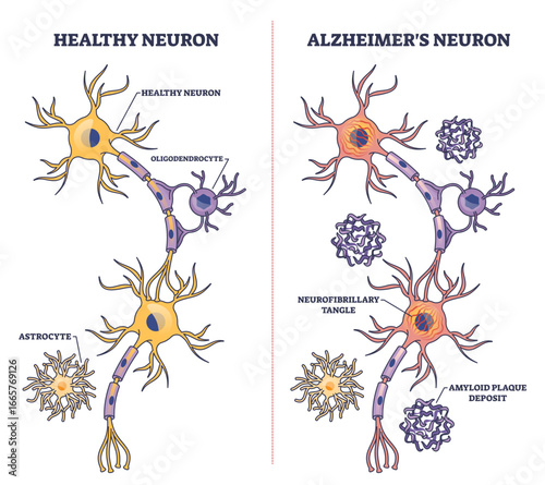 Alzheimers neuron diagram shows comparison of healthy and diseased neurons, highlighting amyloid plaques and neurofibrillary tangles, transparent background.