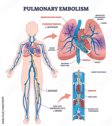 Pulmonary embolism diagram shows a blood clot blocking a lung artery, highlighting embolus, lungs, and blood vessels, transparent background.