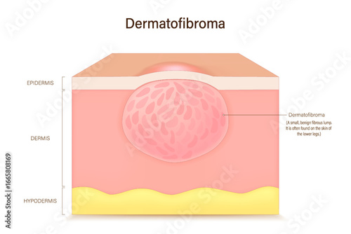 Dermatofibroma. Benign fibrous histiocytomas. skin fibroma. Vector for advertising about beauty and medical treatment. Skin problems.