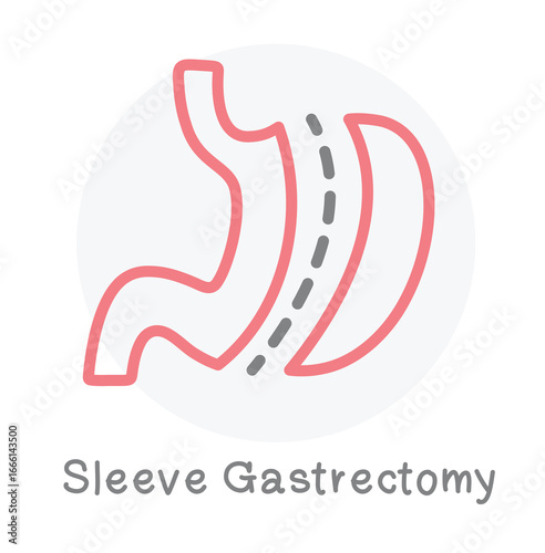 Sleeve gastrectomy surgery medical.
