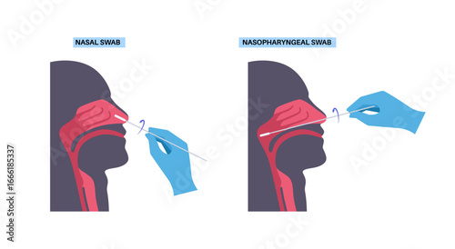 Nasopharyngeal and nasal swab