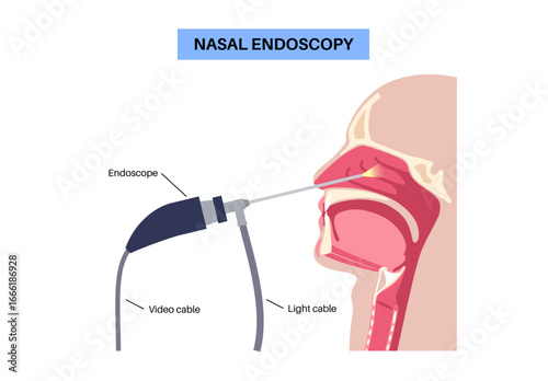 Nasal endoscopy poster