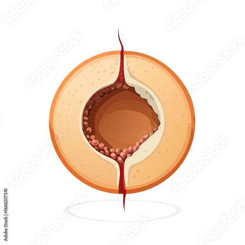 Abscess illustration displaying infection symptoms pus and inflammation for medical or science educational visuals