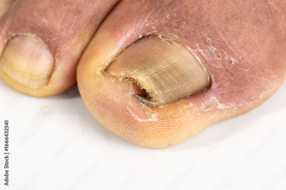 Fototapeta premium Ingrown toenail on a senior feet with white background Close-up ingrown toenail on senior feet with white background.