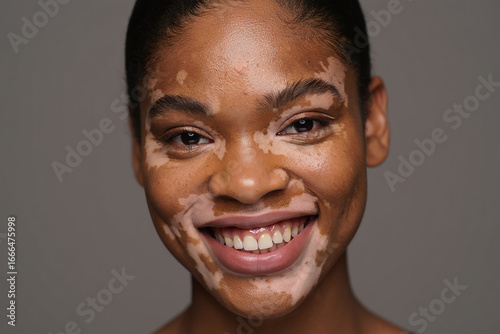 Smiling Woman With Vitiligo Showing Skin Patches face