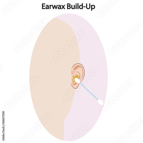 Vector showing earwax build-up with symptoms like blockage, reduced hearing, itching, discomfort; includes similar conditions such as otitis externa and foreign body obstruction. silhouette