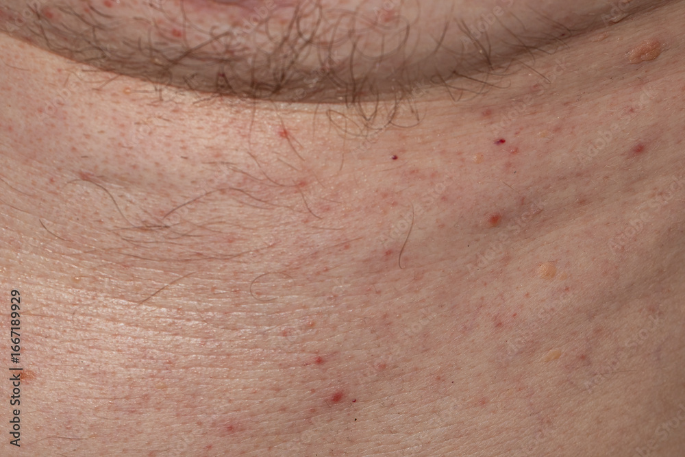 Fototapeta premium Macro image of irritated male skin on the neck, showing hair follicles, blemishes, and dermatological imperfections. Ideal for use in skincare, dermatology, educational, or health-related visuals