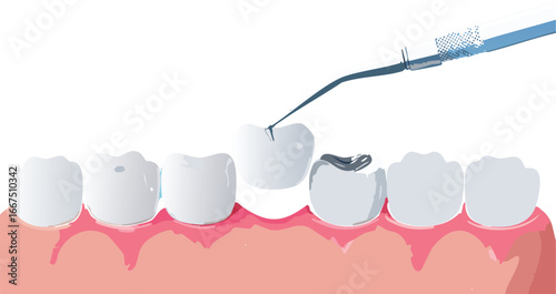 Educational dental illustration showing tooth decay and inspection with dental tool
Digital artwork of oral health checkup highlighting cavity in a realistic tooth row