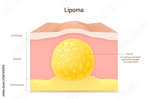 Lipoma. Benign tumor of fat tissue. Adipose tumor. Skin problems.
