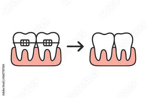 Teeth alignment with dental braces. Before and after orthodontic treatment. Vector illustration of tooth straightening progress. Dental care, hygiene and correction concept.