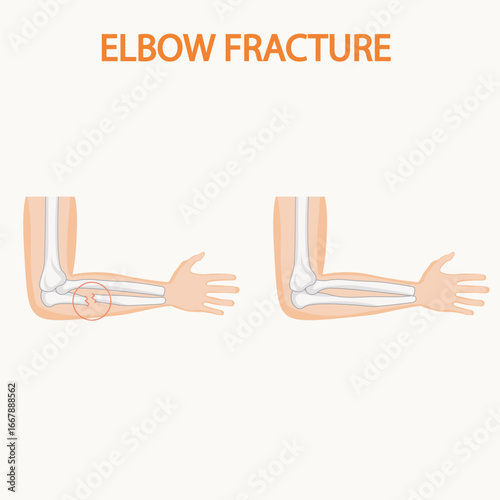 Vector illustration of an elbow showing pain, swelling, and stiffness. Highlights symptoms of tendonitis and bursitis, with visuals distinguishing these from similar joint conditions. hand icon