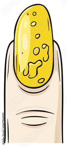 Illustration of an unhealthy yellow fingernail with signs of a fungal infection or disease