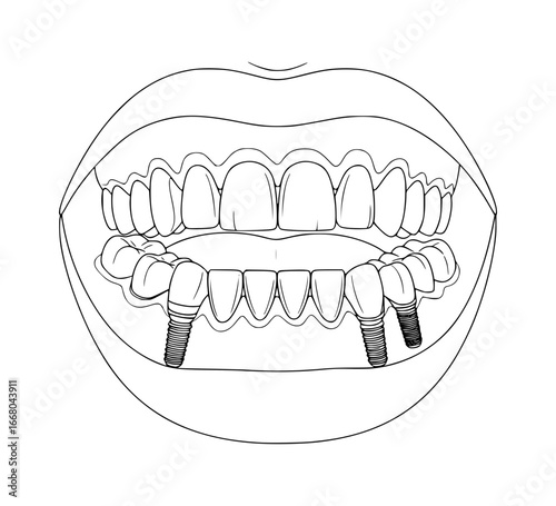 Dental Prosthesis with Four Implants Illustration