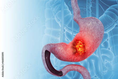 Cancer cells attacking the stomach, gastric cancer, symptoms, stages, treatment, 3d illustration
