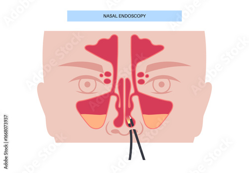 Nasal endoscopy poster