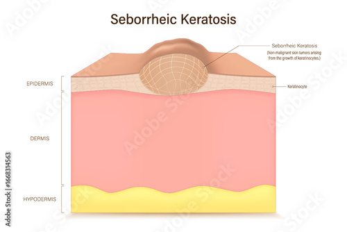 Seborrheic keratosis. Non-malignant skin tumors arising from the growth of keratinocytes. Skin problems.
