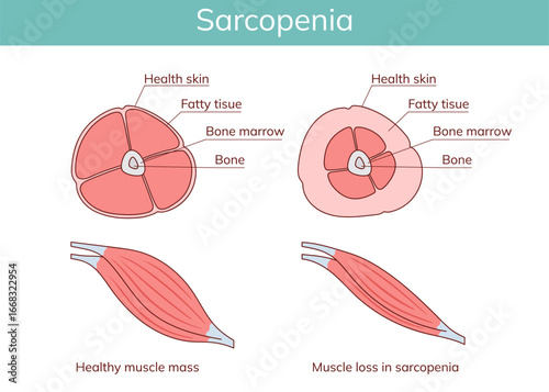 Sarcopenia. Loss of muscle mass.Vector anatomical illustration