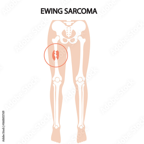 Vector illustration of Ewing sarcoma showing bone pain, swelling, fever, fatigue; highlights similarities to osteomyelitis and osteosarcoma, silhouette