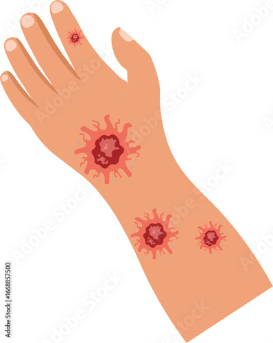 Skin Infection Symptoms on Hand Illustration