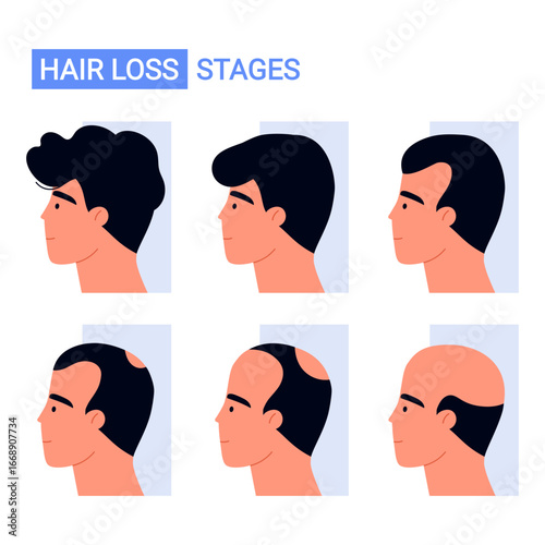 Male hair loss stages from full hair to baldness. Androgenetic alopecia and male pattern baldness progression chart. Isolated vector illustration in cartoon style