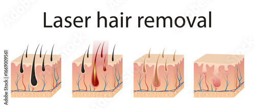 Laser hair removal concept with skin and hair areas. Stages of the removal procedure. Medical diagram before and after using a laser. Vector illustration