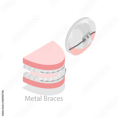 3D Isometric Flat Vector Illustration of Dental Teeth Braces Types, Orthodontic Options for Teeth Straightening. Item 6