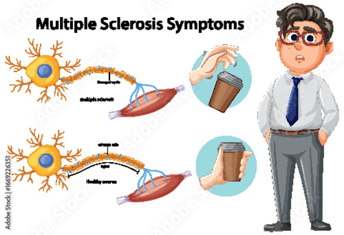 Multiple Sclerosis Symptoms and Neuron Damage Illustration
