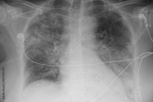 Human lungs with COVID-19 pneumonia, chest X-ray showing bilateral lung infiltrates with interstitial opacities