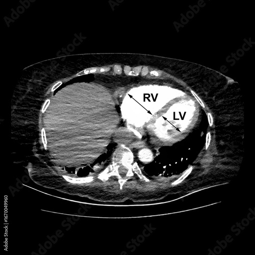 CT scan showing right ventricular strain in a patient with pulmonary embolism, highlighting right ventricular enlargement and flattening of the interventricular septum