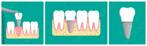 Dental tooth implant steps. Concept of implantation procedure in gum with bone, crown, and screw for restoration.