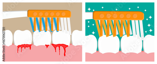 Toothbrush cleaning showing bleeding gum before and plaque clean after with shiny and healthy gum. Dental care.