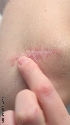captures a forearm scar from melanoma removal being examined closely, highlighting the healing skin texture and the gentle touch, significance of monitoring recovery and skin health