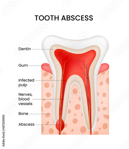 Tooth Abscess Anatomical Illustration of Dental Infection