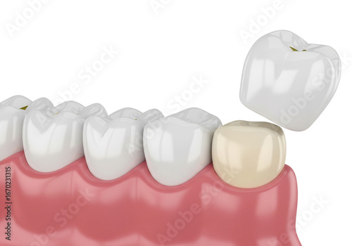 Dental Crown Procedure: 3D Illustration of Tooth Preparation and Restoration with Ceramic Prosthesis