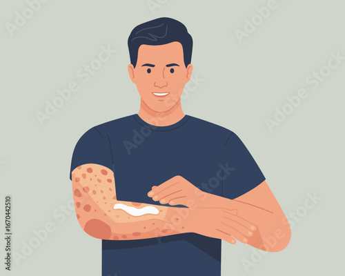 Man Applying Cream to Treat Skin Condition Soothing Eczema with Topical Solution
