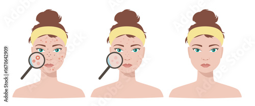 Acne. Girl with acne on her face skin. Vector flat illustration isolated on white background.