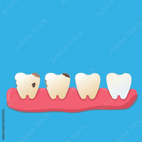 Four teeth in a row show the stages of dental health—from severe decay to perfect cleanliness. A clear visual of oral hygiene progression and gum condition