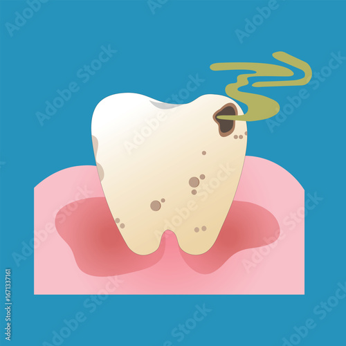 A decayed tooth with brown spots and foul odor, set in inflamed gums. Highlights poor oral hygiene and dental infection risk
