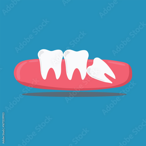 vector of wisdom teeth growing sideways and shifting molars