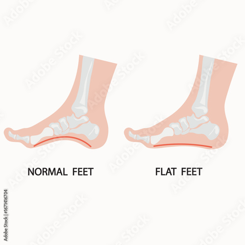 Flat feet vector illustration showing fallen arches, foot pain, swelling and fatigue, with related conditions like plantar fasciitis, overpronation, arthritis and tendonitis silhouette