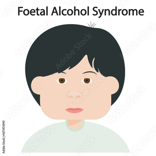 Foetal Alcohol Syndrome vector showing facial abnormalities, growth delay, brain damage, learning difficulties, and behavioral issues, with related disorders like ADHD and autism spectrum conditions.